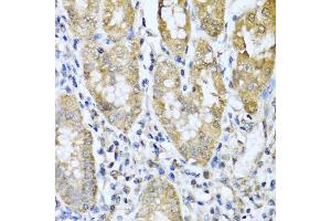 Immunohistochemistry of paraffin-embedded human gastric cancer using ASIP antibody (ABIN5974140) at dilution of 1/100 (40x lens). (ASIP anticorps)
