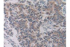 IHC-P analysis of Human Prostate Gland Cancer Tissue, with DAB staining. (SLC12A3 anticorps  (AA 867-1024))