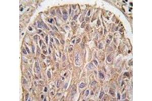 IHC analysis of FFPE human lung carcinoma tissue stained with IKK beta antibody