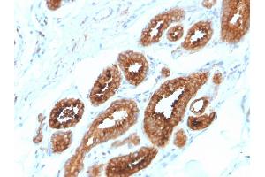 Formalin-fixed, paraffin-embedded human Breast Carcinoma stained with HER-4 / ERBB4 Mouse Monoclonal Antibody (ERBB4/2581).