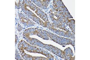 Immunohistochemistry of paraffin-embedded human colon carcinoma using Nesprin 1 Rabbit pAb (ABIN7270520) at dilution of 1:100 (40x lens). (SYNE1 anticorps)