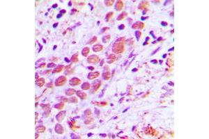 Immunohistochemical analysis of USF2 staining in human breast cancer formalin fixed paraffin embedded tissue section.