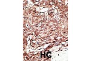 Formalin-fixed and paraffin-embedded human hepatocellular carcinoma tissue reacted with the primary antibody, which was peroxidase-conjugated to the secondary antibody, followed by AEC staining. (PRMT7 anticorps  (N-Term))