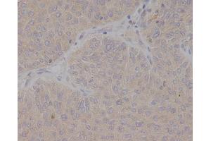 Immunohistochemical analysis of paraffin-embedded human bladder cancer, using GCET2 Antibody.