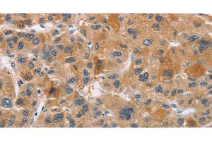 Immunohistochemistry of paraffin-embedded Human liver cancer using CYP4A11 Polyclonal Antibody at dilution of 1:30 (CYP4A11 anticorps)