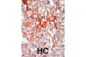 Formalin-fixed and paraffin-embedded human hepatocellular carcinoma tissue reacted with MATK polyclonal antibody  , which was peroxidase-conjugated to the secondary antibody, followed by DAB staining. (MATK anticorps  (N-Term))