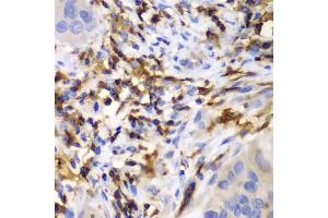 Immunohistochemistry of paraffin-embedded human liver cancer using HCLS1 antibody (ABIN3023093, ABIN3023094, ABIN3023095 and ABIN6219386) at dilution of 1:100 (40x lens).