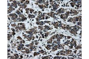 Immunohistochemical staining of paraffin-embedded Carcinoma of liver tissue using anti-BRAFmouse monoclonal antibody. (BRAF anticorps)