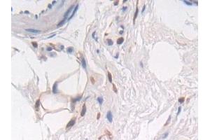 Detection of PTPRB in Human Stomach cancer Tissue using Polyclonal Antibody to Protein Tyrosine Phosphatase Receptor Type B (PTPRB)