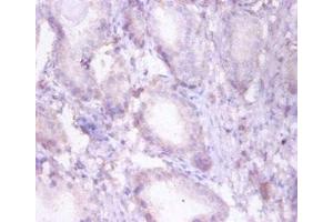 Immunohistochemistry of paraffin-embedded human prostate tissue using ABIN7173377 at dilution of 1:50 (HADHB anticorps  (AA 35-283))
