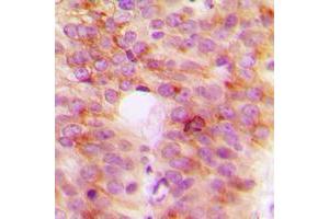 Immunohistochemical analysis of TANK staining in human breast cancer formalin fixed paraffin embedded tissue section.