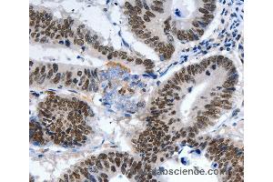 Immunohistochemistry of Human ovarian cancer using LRP5 Polyclonal Antibody at dilution of 1:55 (LRP5 anticorps)