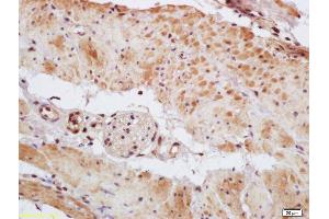 Formalin-fixed and paraffin embedded human gastric carcinoma labeled with Rabbit Anti Phospho-MEF2A (Thr312) Polyclonal Antibody, Unconjugated (ABIN743768) at 1:200 followed by conjugation to the secondary antibody and DAB staining (MEF2A anticorps  (pThr312))