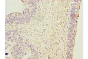 Immunohistochemistry of paraffin-embedded human ovarian cancer using ABIN7150502 at dilution of 1:100 (DNAJB1 anticorps  (AA 1-340))