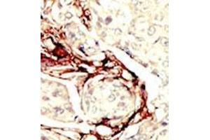 Formalin-fixed and paraffin-embedded human cancer tissue (breast carcinoma) reacted with the primary antibody, which was peroxidase-conjugated to the secondary antibody, followed by DAB staining. (LKB1 anticorps  (N-Term))