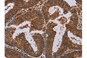 The image on the left is immunohistochemistry of paraffin-embedded Human colon cancer tissue using ABIN7130067(LCMT1 Antibody) at dilution 1/20, on the right is treated with fusion protein.
