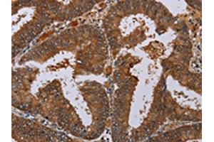 The image on the left is immunohistochemistry of paraffin-embedded Human colon cancer tissue using ABIN7130067(LCMT1 Antibody) at dilution 1/20, on the right is treated with fusion protein. (LCMT1 anticorps)