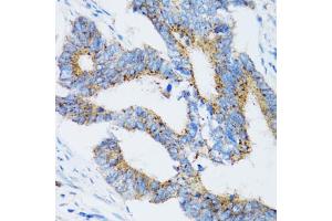 Immunohistochemistry of paraffin-embedded human colon carcinoma using SIAH1 antibody (ABIN5971329) at dilution of 1/100 (40x lens). (SIAH1 anticorps)