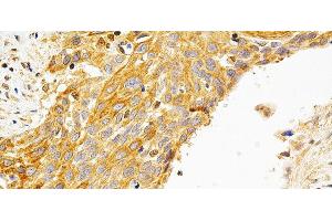 Immunohistochemistry of paraffin-embedded Human esophageal cancer using PRKCE Polyclonal Antibody at dilution of 1:200 (40x lens). (PKC epsilon anticorps)