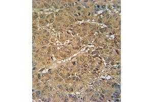 VKORC1 Antibody (N-term) (ABIN652040 and ABIN2840514) immunohistochemistry analysis in formalin fixed and paraffin embedded human hepatocarcinoma followed by peroxidase conjugation of the secondary antibody and DAB staining. (VKORC1 anticorps  (N-Term))