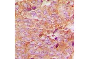 Immunohistochemical analysis of MKK6 staining in human breast cancer formalin fixed paraffin embedded tissue section. (MAP2K6 anticorps  (N-Term))