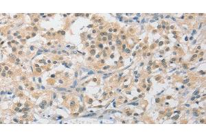 Immunohistochemistry of paraffin-embedded Human thyroid cancer tissue using APLF Polyclonal Antibody at dilution 1:40 (APLF anticorps)