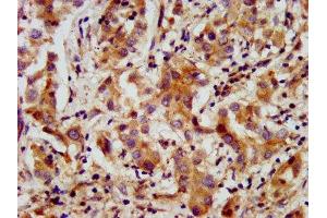 IHC image of ABIN7144009 diluted at 1:200 and staining in paraffin-embedded human liver cancer performed on a Leica BondTM system. (AMMECR1 anticorps  (AA 146-248))
