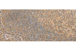 Immunohistochemistry of paraffin-embedded Human tonsil tissue using RAC3 Polyclonal Antibody at dilution of 1:45(x200)