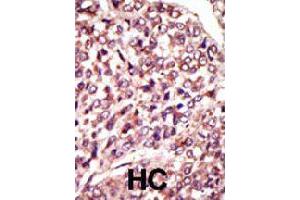 Formalin-fixed and paraffin-embedded human hepatocellular carcinoma tissue reacted with MGAT1 polyclonal antibody  , which was peroxidase-conjugated to the secondary antibody, followed by AEC staining . (MGAT1 anticorps  (C-Term))