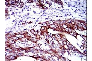 Immunohistochemical analysis of paraffin-embedded stomach cancer tissues using CK5 mouse mAb with DAB staining.