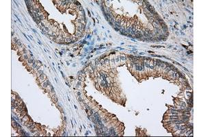 Immunohistochemical staining of paraffin-embedded Adenocarcinoma of ovary tissue using anti-ALDH3A1 mouse monoclonal antibody. (ALDH3A1 anticorps)