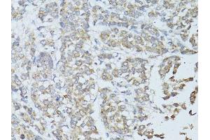 Immunohistochemistry of paraffin-embedded human colon carcinoma using TEFM antibody. (TEFM anticorps  (AA 36-210))