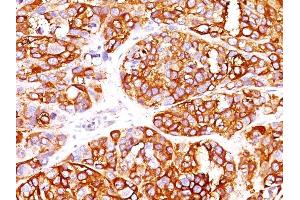 Formalin-fixed, paraffin-embedded human Melanoma stained with MART-1 Rabbit Recombinant Monoclonal Antibody (MLANA/1409R). (Recombinant MLANA anticorps)