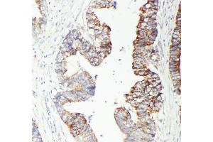 Anti-GST3/GST pi antibody, IHC(P) IHC(P): Human Intestinal Cancer Tissue (GSTP1 anticorps  (N-Term))