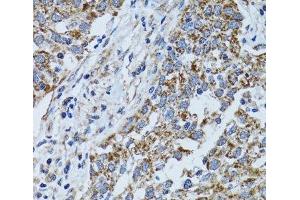 Immunohistochemistry of paraffin-embedded Human lung cancer using ATP5B Polyclonal Antibody at dilution of 1:100 (40x lens). (ATP5B anticorps)