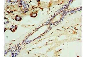 Immunohistochemistry of paraffin-embedded human breast cancer using ABIN7146290 at dilution of 1:100 (CALCB anticorps  (AA 1-127))