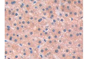 DAB staining on IHC-P; Samples: Human Liver cancer Tissue (IL13 Receptor alpha 1 anticorps  (AA 203-376))