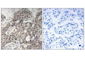 Immunohistochemistry analysis of paraffin-embedded human breast carcinoma tissue using RPL3 antibody. (RPL3 anticorps  (Internal Region))