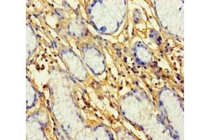Immunohistochemistry of paraffin-embedded human gastric cancer using ABIN7164709 at dilution of 1:100 (Prokineticin Receptor 1 anticorps  (AA 1-62))