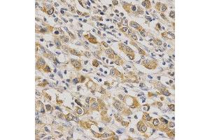 Immunohistochemistry of paraffin-embedded human stomach cancer using ERG antibody at dilution of 1:200 (x400 lens). (ERG anticorps  (AA 1-280))