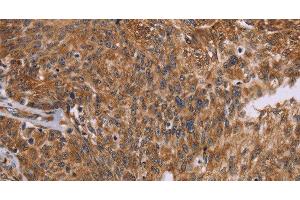 Immunohistochemistry of paraffin-embedded Human ovarian cancer using PPIB Polyclonal Antibody at dilution of 1:45