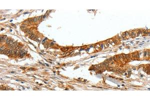 Immunohistochemistry of paraffin-embedded Human colon cancer tissue using COL1A2 Polyclonal Antibody at dilution 1:70 (COL1A2 anticorps)