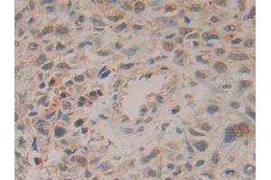 Detection of HPRT1 in Human Lung cancer Tissue using Polyclonal Antibody to Hypoxanthine Phosphoribosyltransferase 1 (HPRT1)