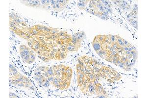 ABIN6255023 and ABIN6267139 at 1/100 staining Human esophageal cancer by IHC-P. (MFF anticorps  (pSer146, pSer172))