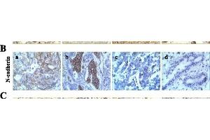Expression of E-cadherin, N-cadherin, and vimentin in human breast tumor tissues.