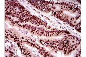Immunohistochemical analysis of paraffin-embedded colon cancer tissues using TWIST1 mouse mAb with DAB staining.