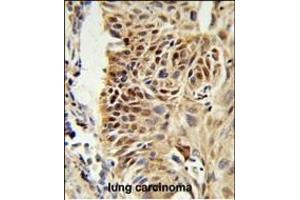 CIRBP Antibody (C-term) (ABIN653083 and ABIN2842680) IHC analysis in formalin fixed and paraffin embedded human lung carcinoma followed by peroxidase conjugation of the secondary antibody and DAB staining. (CIRBP anticorps  (C-Term))