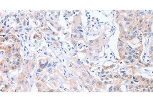 Immunohistochemistry of paraffin-embedded Human lung cancer tissue using CDCA4 Polyclonal Antibody at dilution 1:50