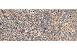 Immunohistochemistry of paraffin-embedded Human cervical cancer tissue using EIF1AX Polyclonal Antibody at dilution of 1:65(x200) (EIF1AX anticorps)
