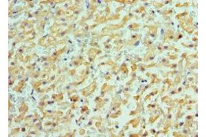 Immunohistochemistry of paraffin-embedded human liver cancer using ABIN7143181 at dilution of 1:100